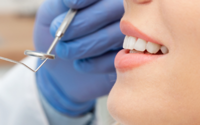Caries dental: Causas, prevención y tratamientos