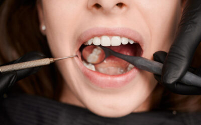 La Importancia de Tratar las Caries: Conservando Sonrisas y Salud