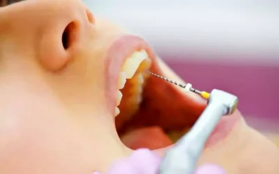 Todo lo que necesitas saber sobre el tratamiento de endodoncia: Recuperando la salud dental con eficacia